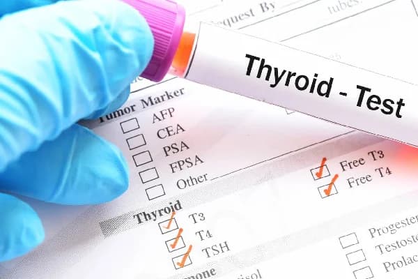 Thyroid Profile (T3, T4, TSH)